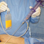 Containment Bags and Transfer Tube Set for Lipografter